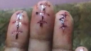 விரல்களில் அறுவை சிகிச்சை