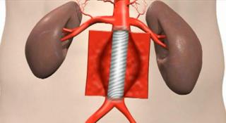 aorta