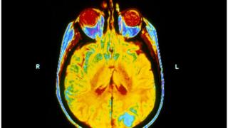 MRI scan showing secondary brain tumours