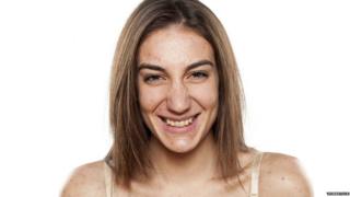 Mujer con acné