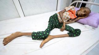 Saida Ahmad Baghili en la cama de un hospital en Yemen.