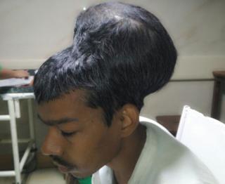 સંતલાલ પાલનો તેમના મગજની ગાંઠ સાથેની તસવીર