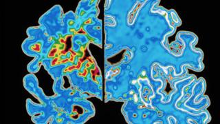 Scan of brain showing Alzheimer's vs normal