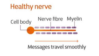 An illustration of a healthy nerve