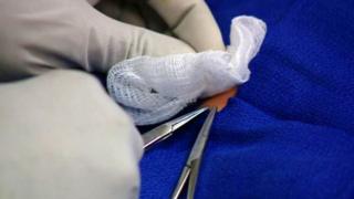 Italy home circumcision kills child