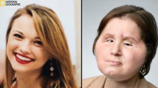 Katie Stubblefield ameliyat öncesi ve sonrası