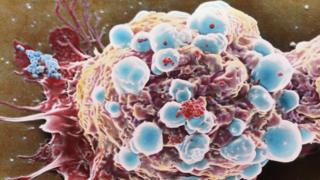 Breast cancer cell