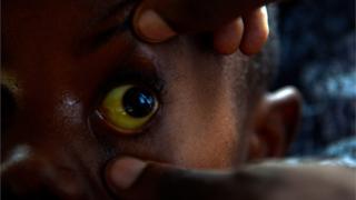 Yello Eyes of Sickle Cell Patient