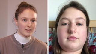 Flora Cox, a Leeds student, had mumps