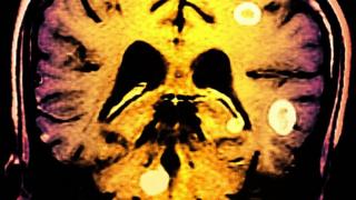 Imagen de cerebro infectado