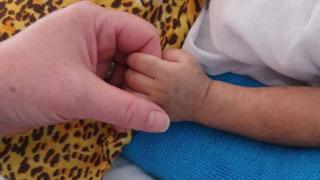 Baby with measles