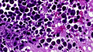 Light micrograph of myeloma blood cancer