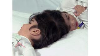 샴쌍둥이 사파와 마르와