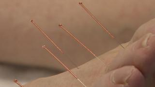 Malcolm Kavanagh receiving acupuncture