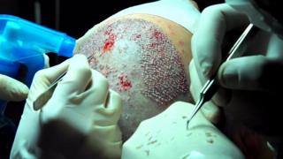 كيف تعمل تقنية زراعة الشعر؟