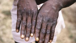Monkeypox: Search for 200 people in 27 U.S. states to ...