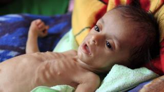 A malnourished Yemeni child receives treatment at a hospital in the capital Sanaa on November 22, 2017.