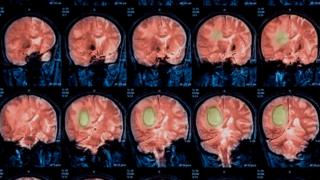 Escáner del cerebro