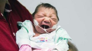 bebe con microcefalia