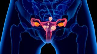 Uterine fibroma, drawing