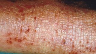 Eczema