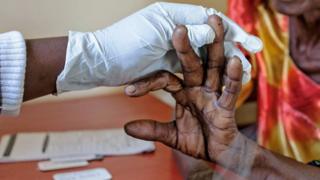 Perawatan malaria