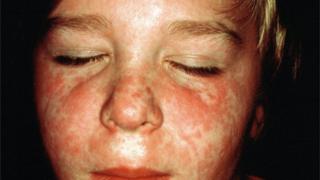 boy with measles