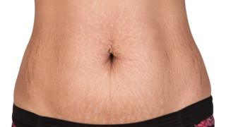 Estrías en el abdomen