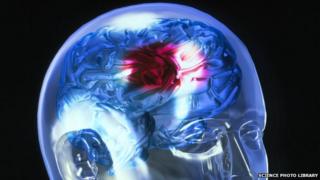 Blood clot in the brain