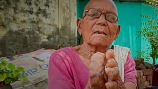 Leprosy