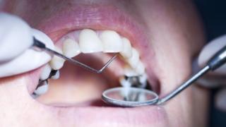 dental fillings
