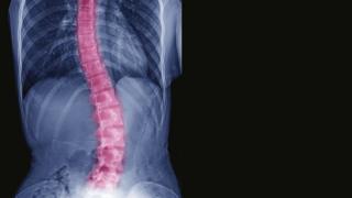 Curved spine in scoliosis