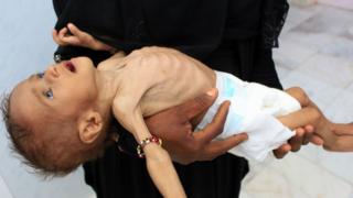 Yemen'de yetersiz beslenmiş bir çocuk