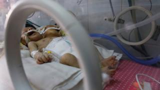Conjoined twin boys born in Sanaa, Yemen (6 February 2019)