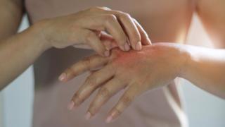 Mujer con psoriasis.