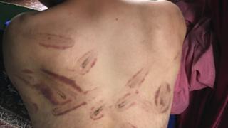 Signs of torture on the back of a man in Kashmir