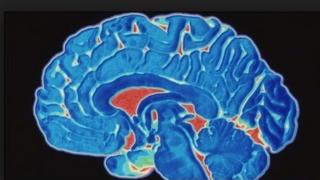 Brain scan