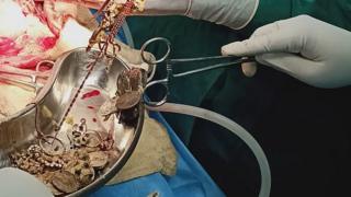 তরুণীর পেট থেকে বের করা হচ্ছে অলংকার