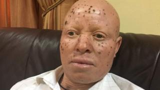 A man with albinism