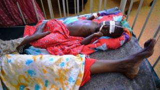 Hépatite : plus de 52 millions d'enfants atteints dans le monde
