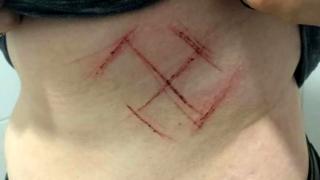 Foto de una esvástica marcada en la piel de una mujer.