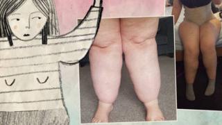 Imágenes de lipedema