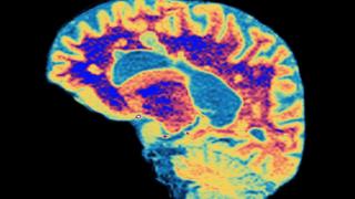 Early MS scans ‘can predict long-term prognosis’