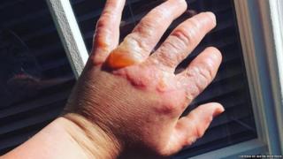 Mano con lesiones por fitofotodermatitis