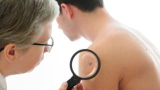Médico examinando un lunar