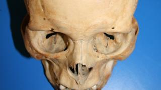 This skull has marks which suggests the individual survived being shot with an arrow