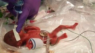 Saybie dirawat di Sharp Mary Birch Hospital