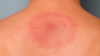 Lyme disease rash