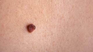 Why do so many people want their moles removed? - BBC News