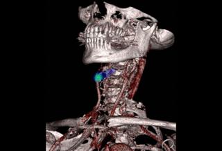 Detecting stroke - Nicholas Evans, University of Cambridge